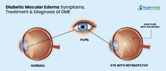 diabetic macular edema