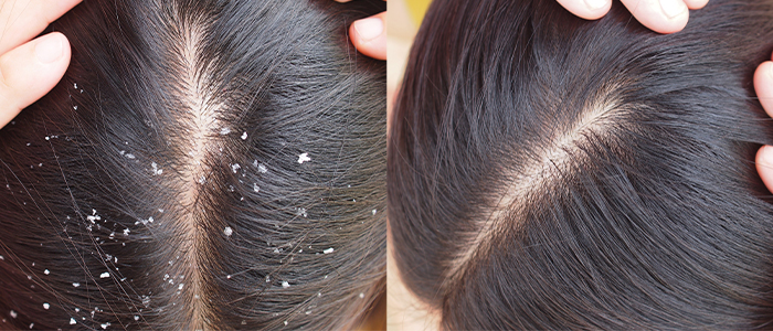 what causes dandruff in hair