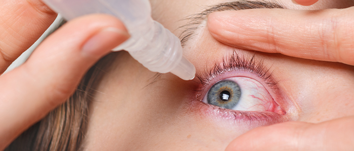 Eye Infection and Irritation: Symptoms, Causes, Home Remedies