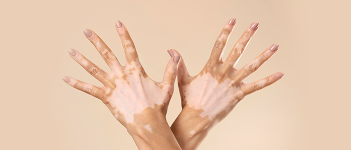 Overview of vitiligo and its treatment