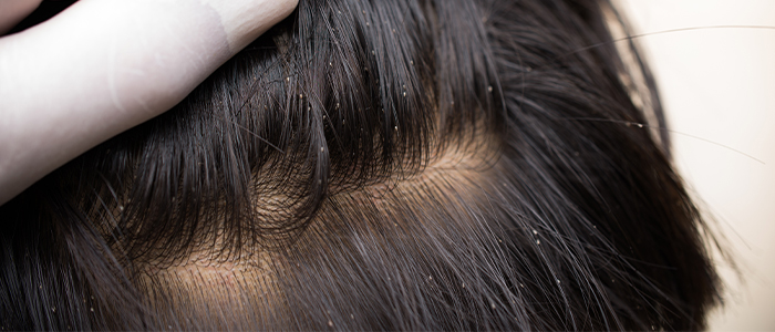 Head lice (lice in the hair): Overview, Causes and Symptoms