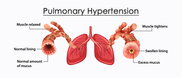 Pulmonary hypertension: Overview, Causes, and symptoms