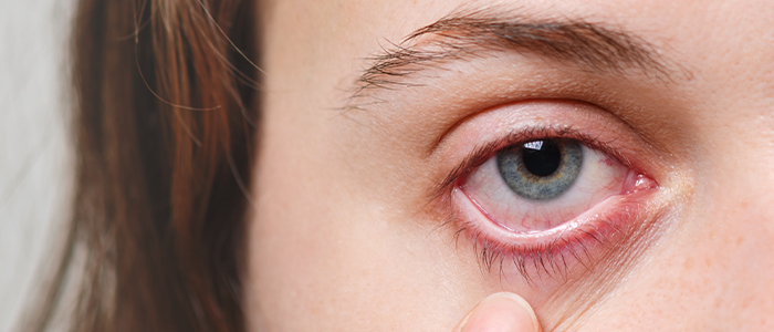 Uveitis: overview, causes, symptoms, and treatment
