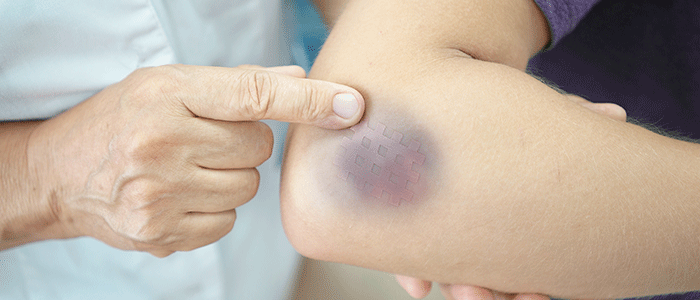 Bruises: symptoms, causes, diagnosis, treatment