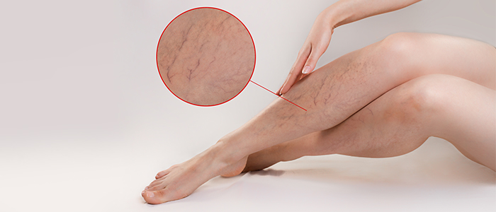 Varicose veins: overview, causes, symptoms, prevention, and treatment