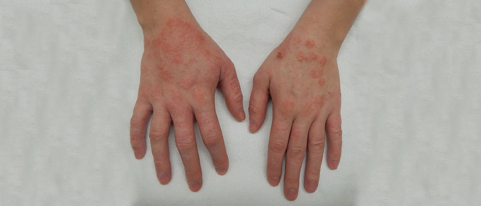 Understanding Eczema: Causes, Symptoms, and Treatments