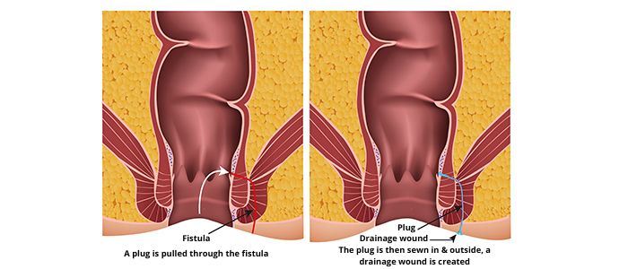 Overview of anus fistula and its treatment