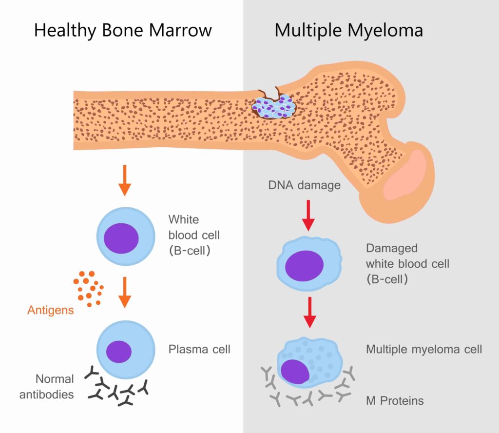 Healthy-bone-marrow-vs-Multiple-myeloma