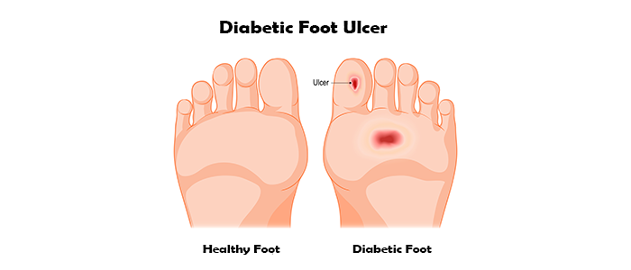 diabetic foot diagram