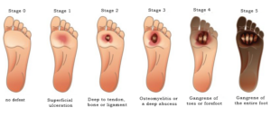 Diabetic Foot Ulcer: Overview, Causes, Symptoms and Treatment