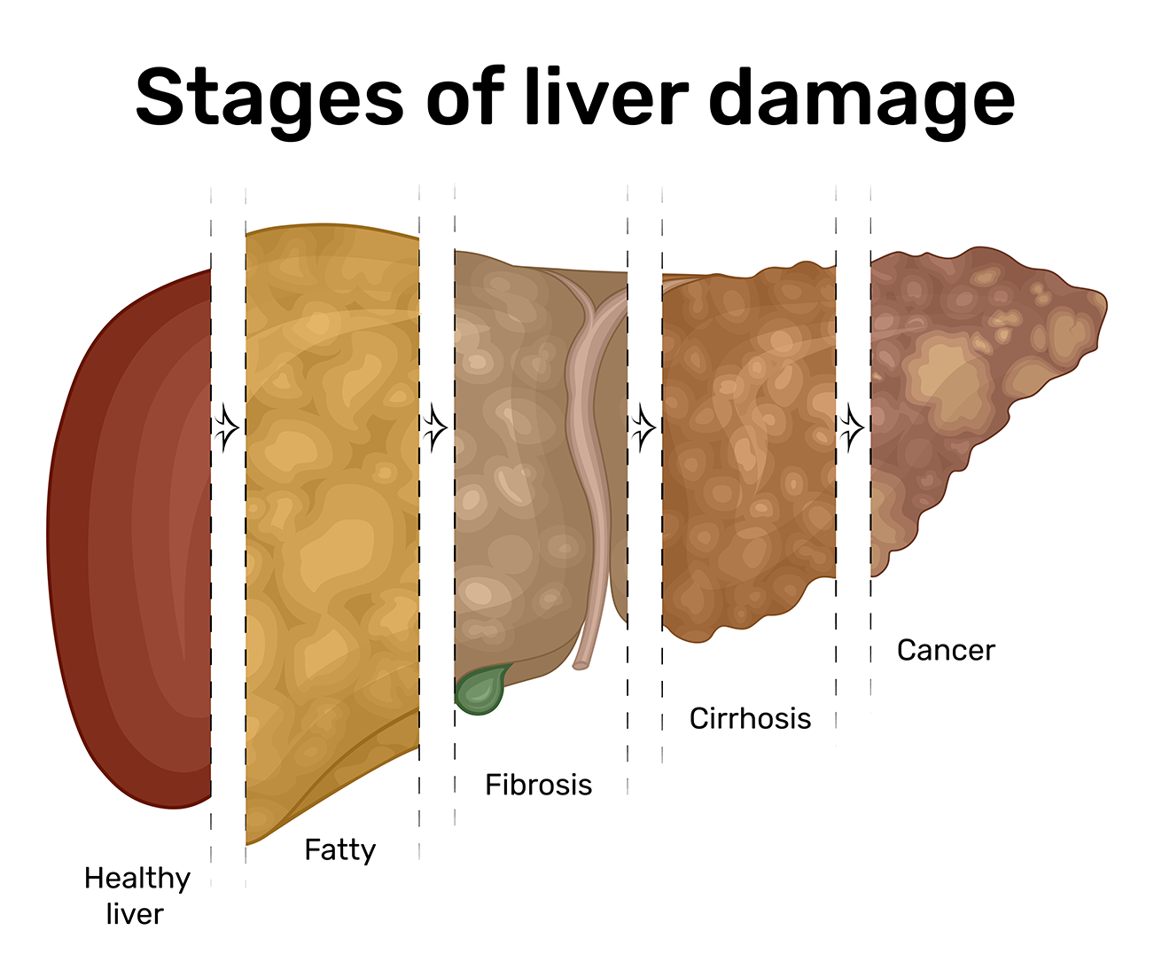 Liver Cancer Overview Stages Treatment And Precautions 