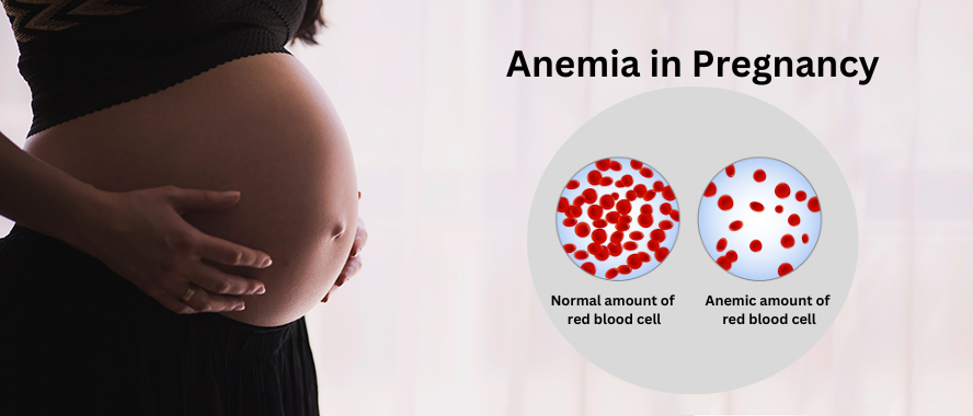 Anaemia in pregnancy: Causes and Symptoms