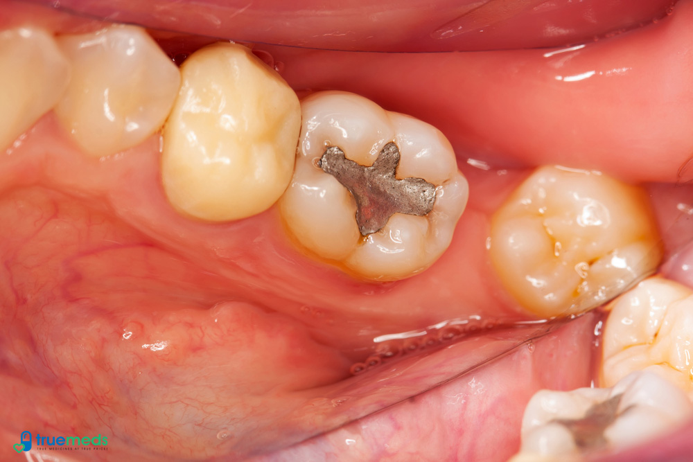 Dental-filling-tooth-filling-teeth-filling-treatment