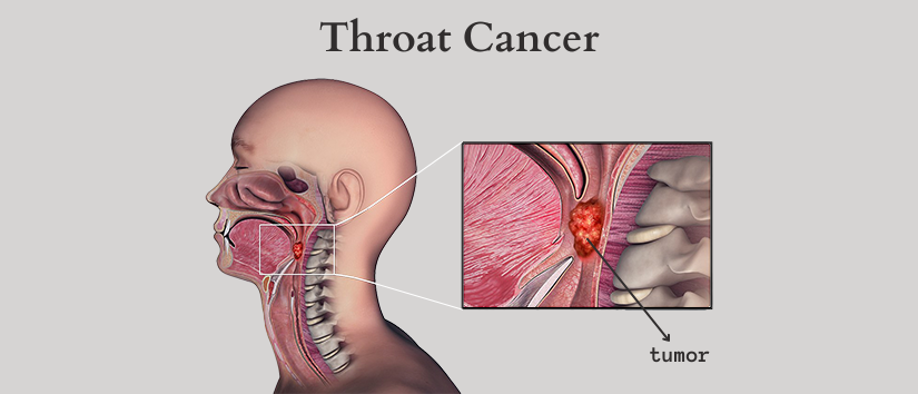 Throat Cancer: Overview, Causes and Symptoms