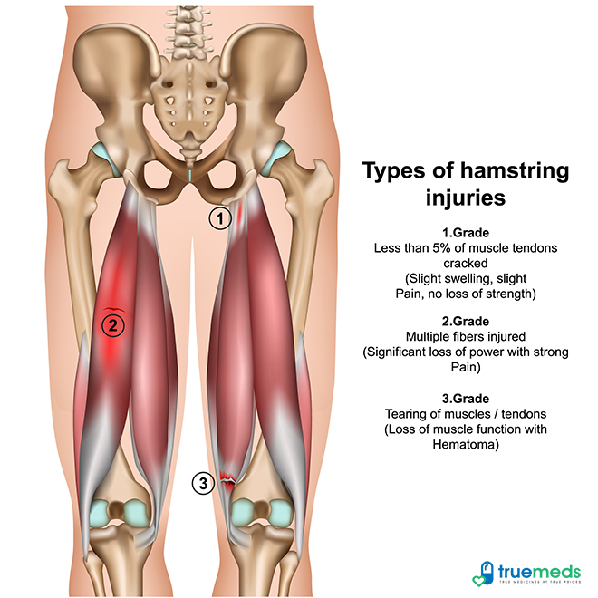 Hamstring Injuries Causes, Symptoms, and Treatment