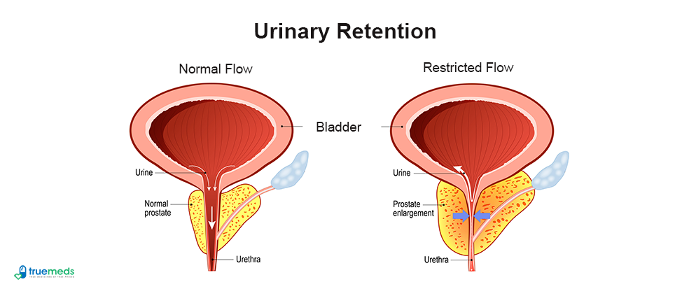 understanding-urinary-retention-symptoms-causes-and-treatments