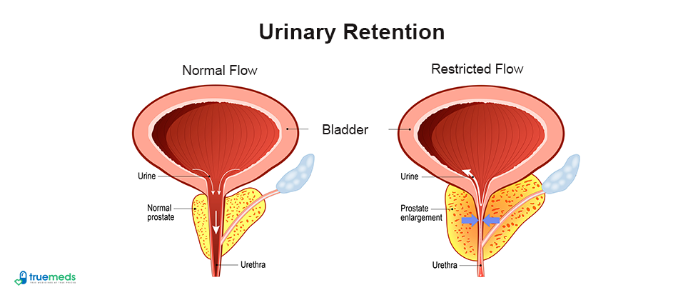 Urinary Retention: Causes, Symptoms, &amp; Treatment