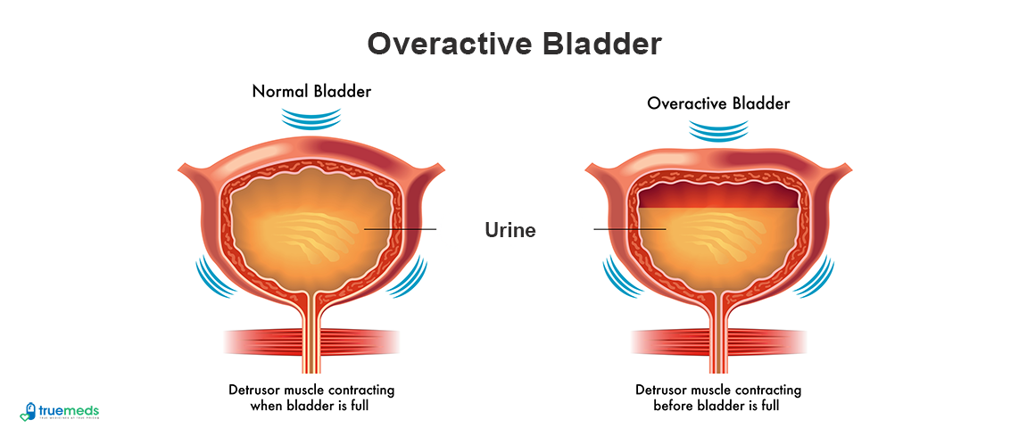 Managing Overactive Bladder