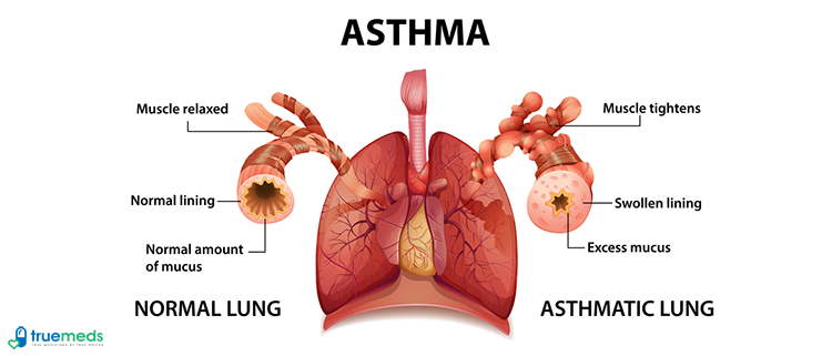 An introduction to asthma symptoms and treatment