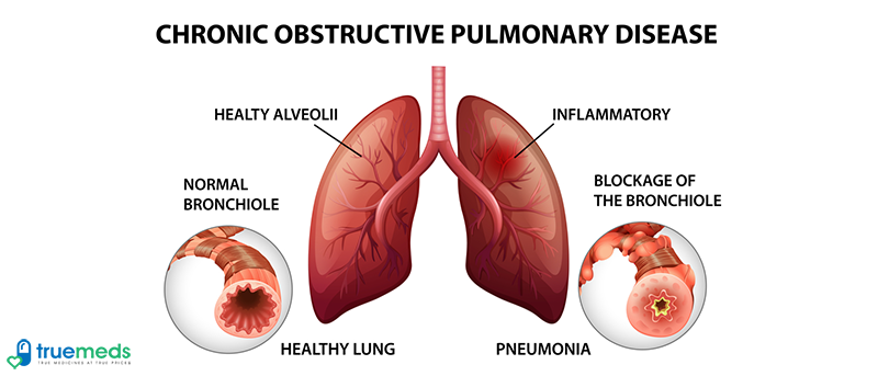 Chronic obstructive pulmonary disease: What you should know