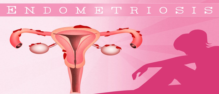 Endometriosis Stages and What These Means