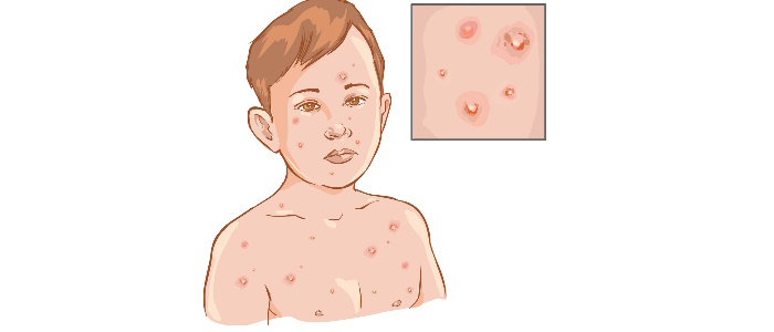 Effective Chickenpox Treatment at Home