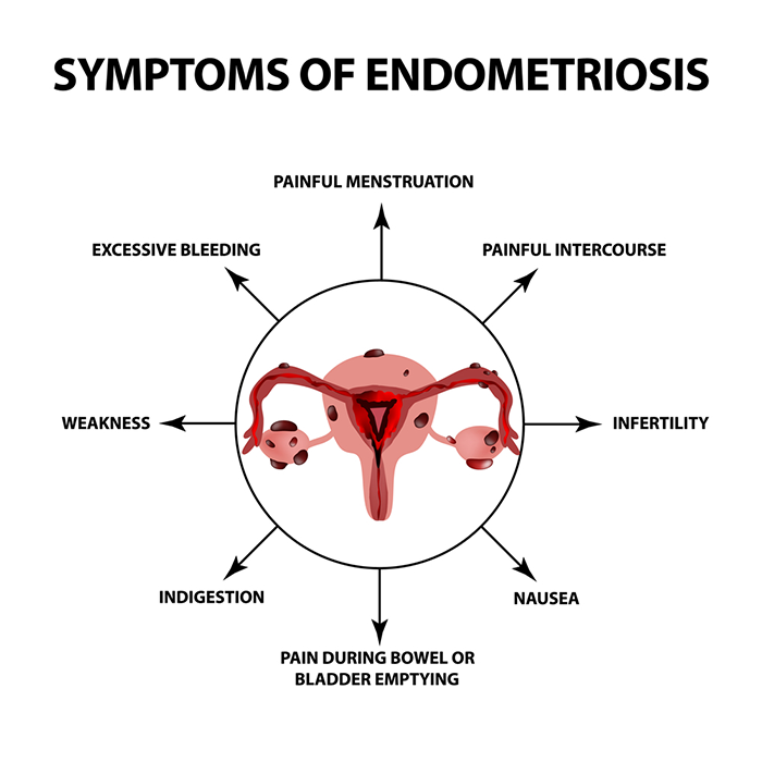 What Are the Stages Of Endometriosis | Endometriosis Symptoms