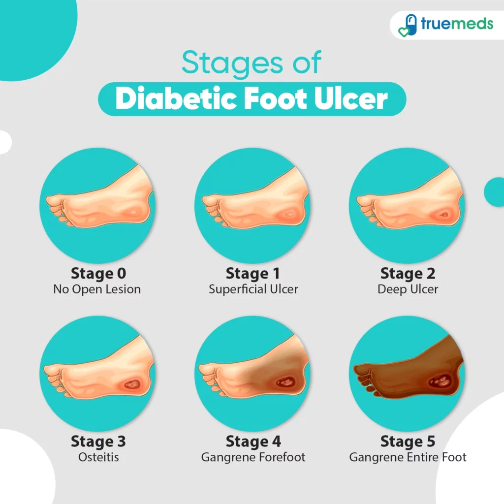stages of diabetic foot ulcer
