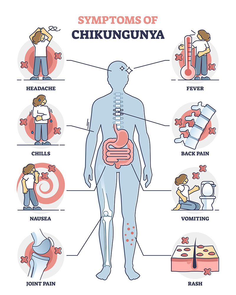 Symptoms-of-Chikungunya-Virus