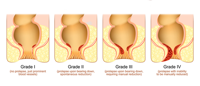 Four Distinct Grades of Hemorrhoids