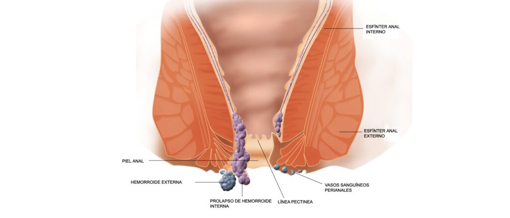 Piles Symptoms Causes Treatment and Home Remedies